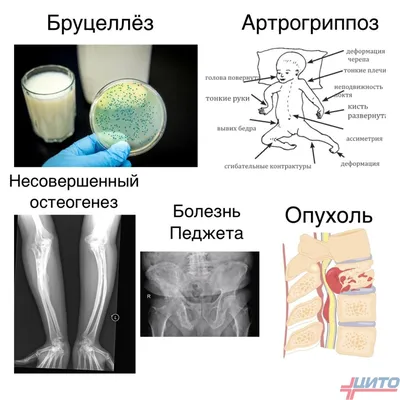 Изображение бруцеллеза человека в высоком качестве