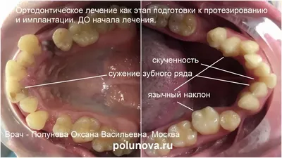 Фото зубов: Изысканные изображения для скачивания