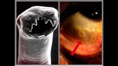 29. Освежи взгляд: Фотографии червей в человеке