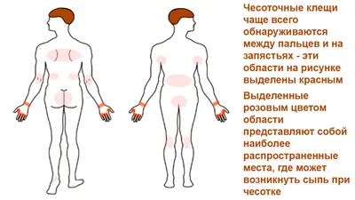 Картинка: Чесотка у человека в формате PNG