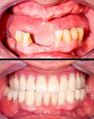 Фото бабочки в стоматологии: яркие и привлекательные картинки на зубах