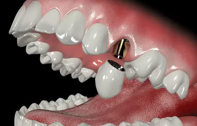 Фото бабочки в стоматологии: впечатляющие и привлекательные картинки на зубах