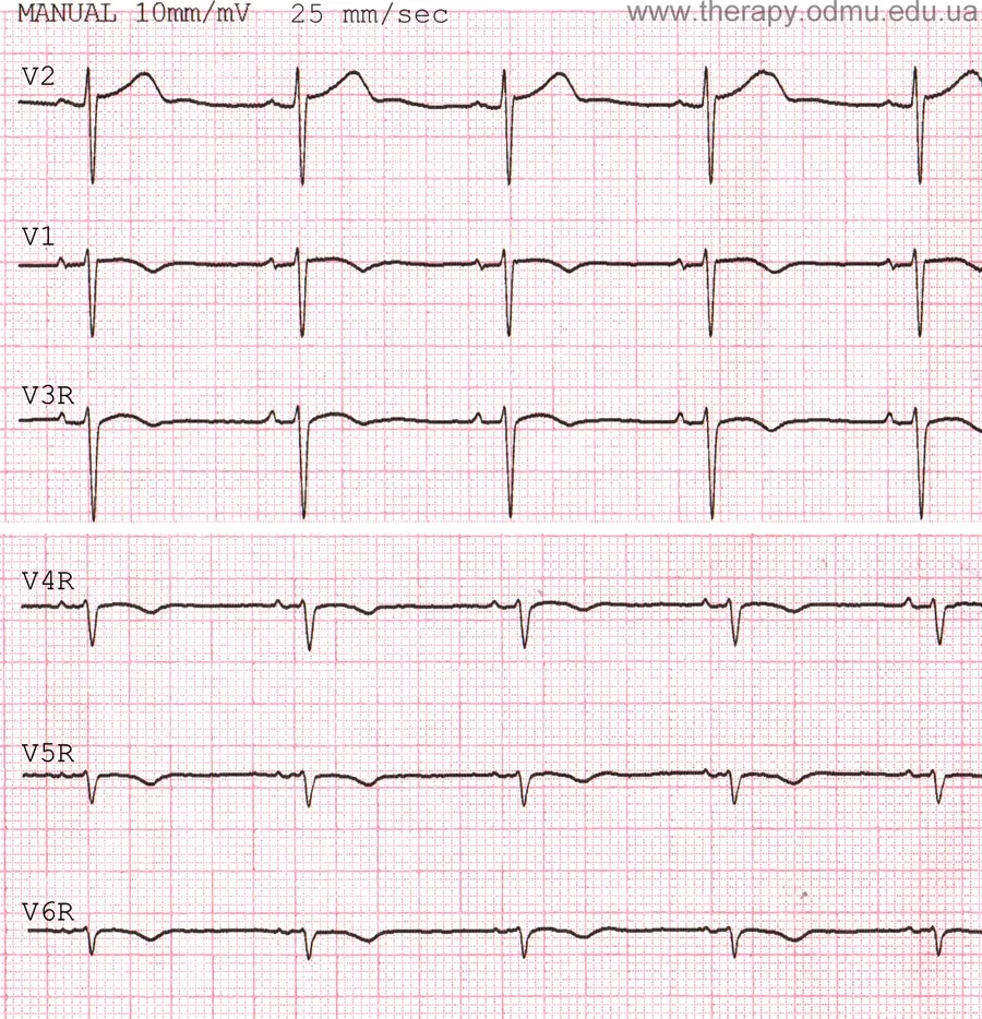 Нормальные показатели ЭКГ - Доказательная медицина для всех