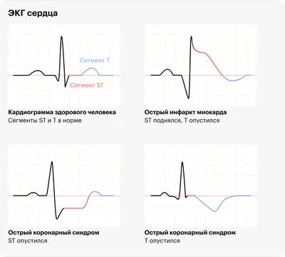 ЭКГ человека: изображение в формате WebP для скачивания