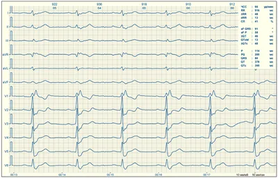 Фото ЭКГ человека: скачайте WebP изображение