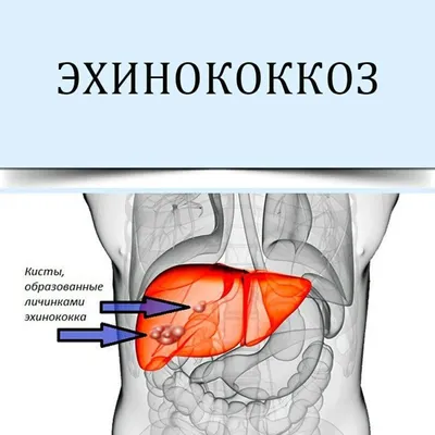 Эхинококкоз у человека фотографии