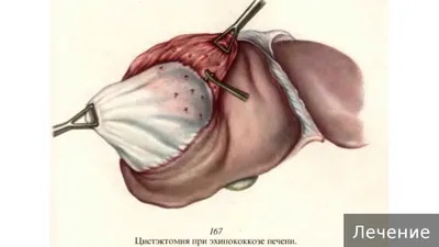 Изображения эхинококкоза человека: фото различных размеров