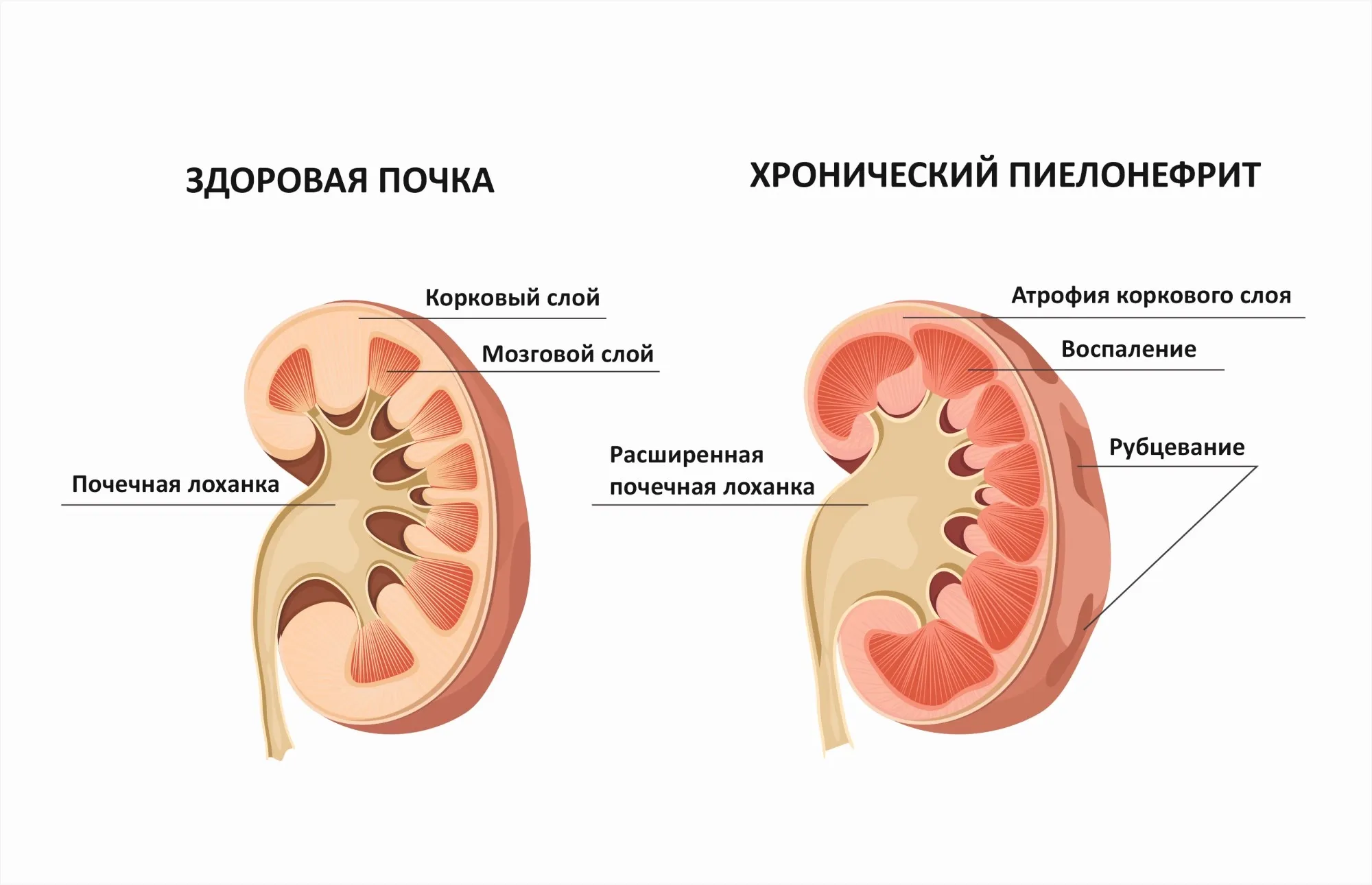 Боль в почках картинка