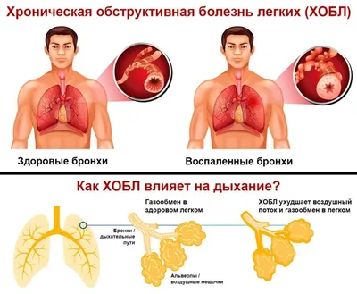 Исследование структуры бронхов: фотографии для скачивания в разных форматах