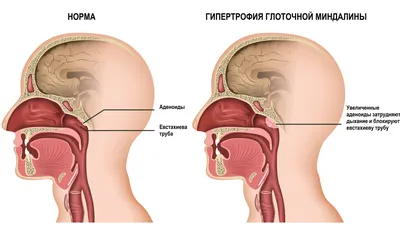 10. Открывайте Тайны: Где Расположены Гланды в Человеческом Теле