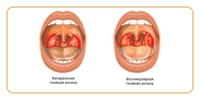 25. Великое Открытие: Где Расположены Гланды с Вариантами Скачивания