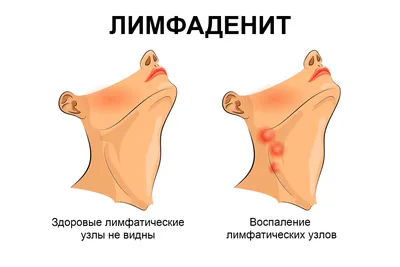 Фотография местонахождения лимфоузлов на шее (JPG)