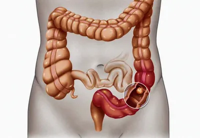 Изображение толстой кишки человека в различных форматах (WebP)