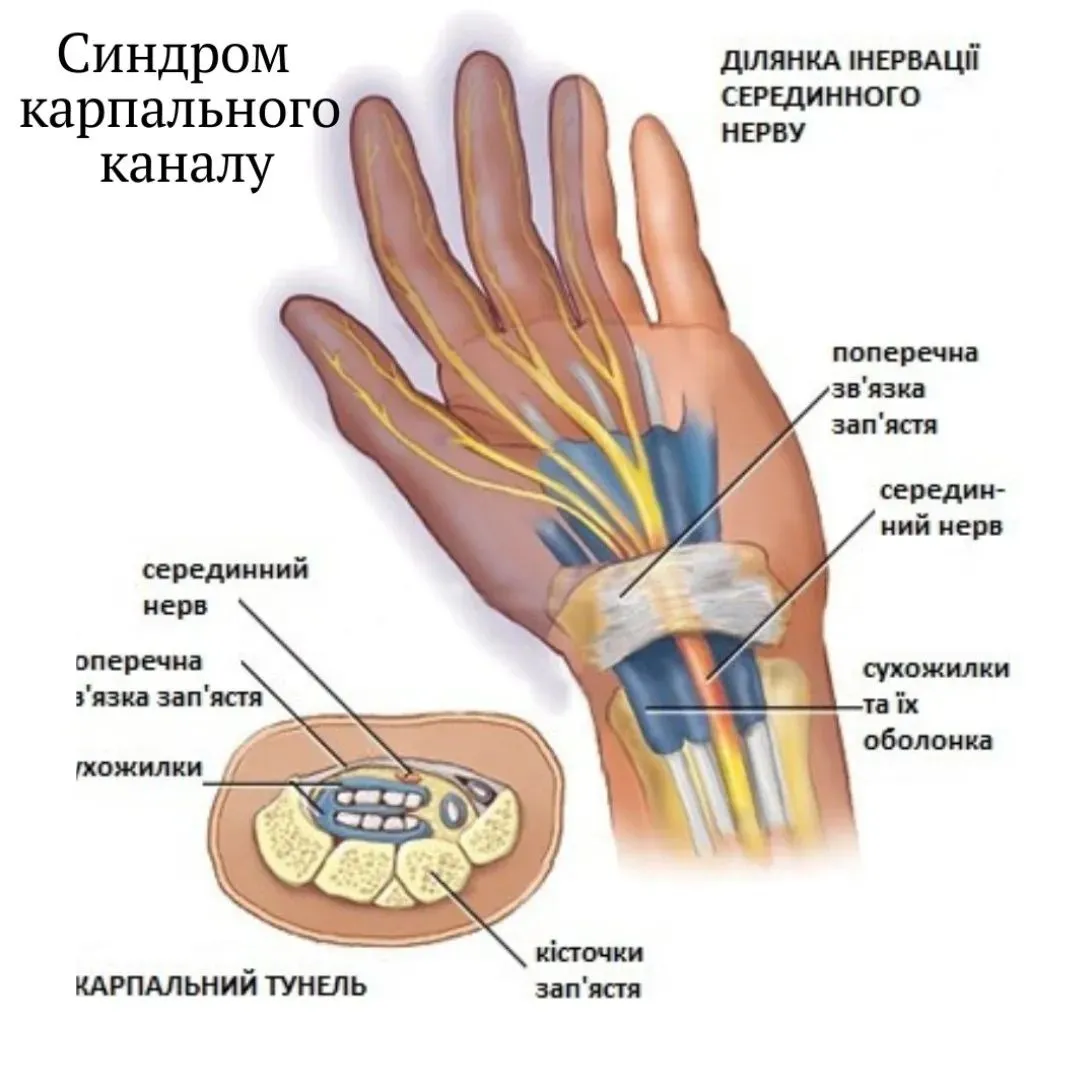 Онемение пальцев после операции. Карпальный туннельный синдром. Карпальный синдром кисти. Синдром карпального канала запястья. Туннельный синдром запястного сустава.