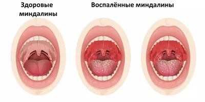 Изображения гланд человека: Скачивайте в любом удобном формате