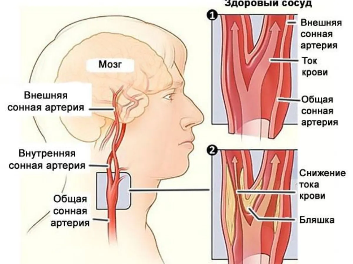 Лечение головных сосудов. Сужение сосудов головного мозга. Общая Сонная артерия. Стеноз внутренней сонной артерии.