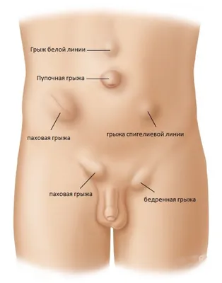 Грыжа у человека фотографии