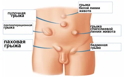 11. Фото человеческих грыж: Выберите формат скачивания