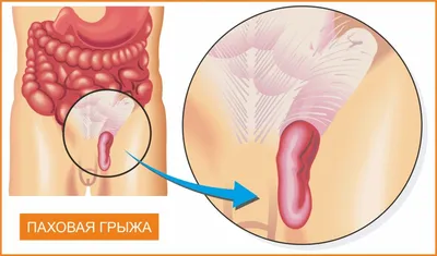 29. Размеры и форматы: Фото грыжи у человека