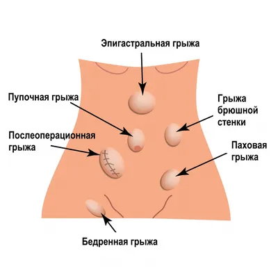 5. Визуализация проблемы: Грыжа на фото