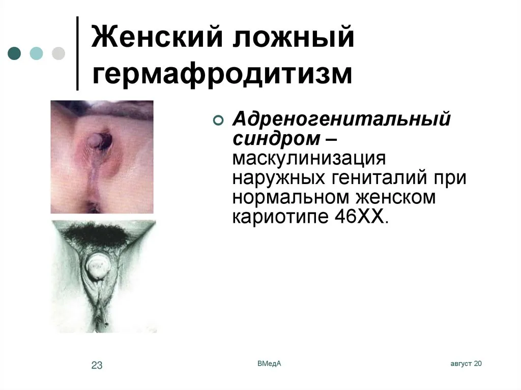Женский псевдогермафродитизм: причины, симптомы и лечение в Москве