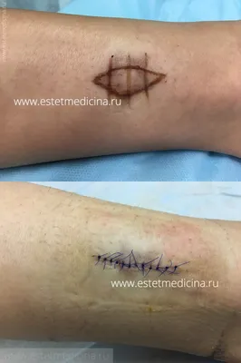 Хирургическое удаление тату: выберите размер и формат your-image.jpg