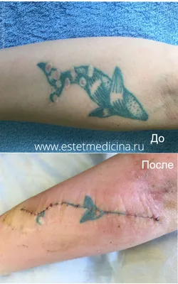 Фото хирургического удаления тату: загрузите вашу картинку и выберите формат скачивания