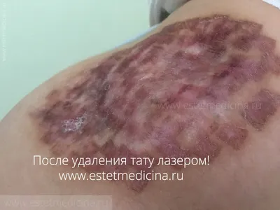 Фотография татуировки перед хирургическим удалением - выберите размер