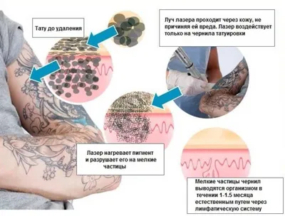 Хирургическое удаление тату: загрузите ваше фото и выберите формат