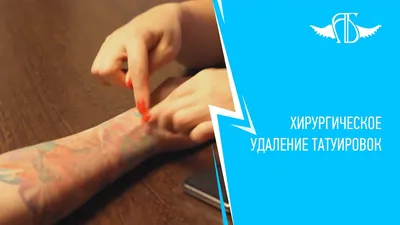 Хирургическое удаление тату - фотофиксация процесса