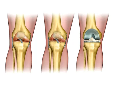 Изображение коленного сустава - WebP для быстрого загрузки