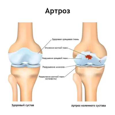 Фото коленного сустава: скачивание в PNG для четкости