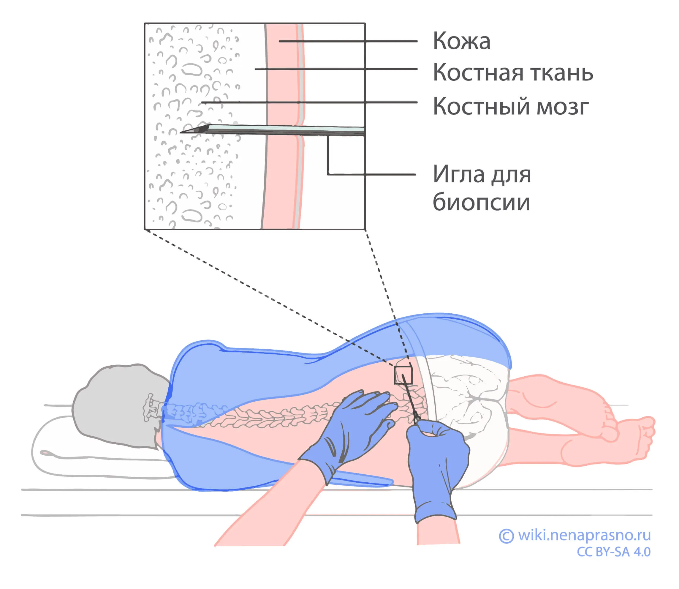 Как происходит забор костного мозга. Взятие костного мозга на анализ. Трепанобиопсии костного мозга.