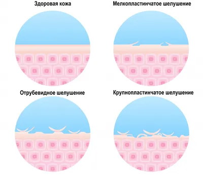 Фото: Кожа на ногах как рыбья чешуя 13 (формат webp)