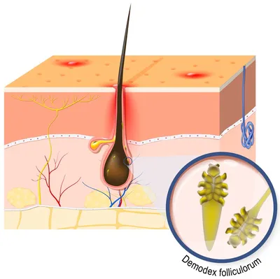 Галерея изображений кожных паразитов у человека (JPG, PNG, WebP)