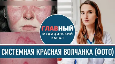 Красная волчанка картинки: Полезная информация о Красной волчанке