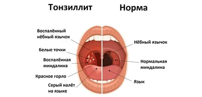 Красное горло у ребенка: скачать изображения в HD, Full HD, 4K