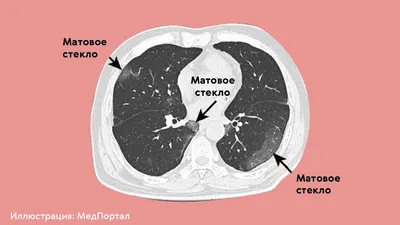 Загрузите свое здоровье: Фотографии легких в JPG, PNG, WebP