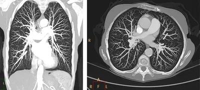 Загляните внутрь: Фотографии КТ легких для скачивания