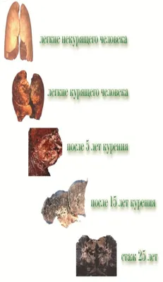 Легкие курильщика и здорового человека в формате JPG