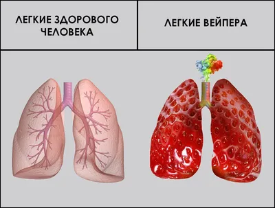 Изображение Легкие курильщика и здорового человека - выберите формат