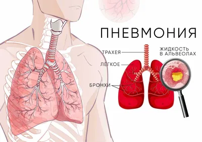 Картинка Легкие курильщика и здорового человека - разные варианты