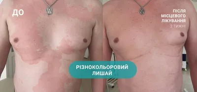 Фото лишая на человеке: разные размеры для загрузки