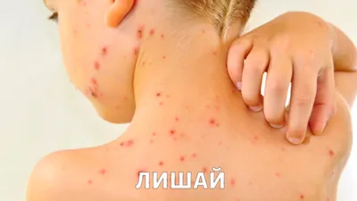 Лишай на теле человека: разные размеры для изображения