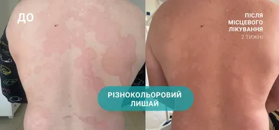 Лишай на коже человека: фотография доступна для скачивания