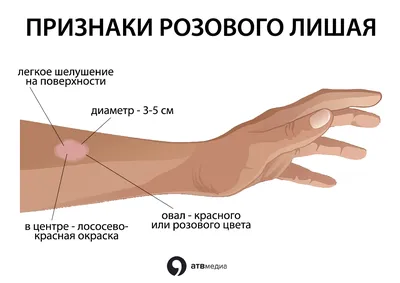 Искусство красивых изображений лишая на руке