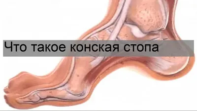 Изображение человека с лошадиной стопой: Разные варианты размеров