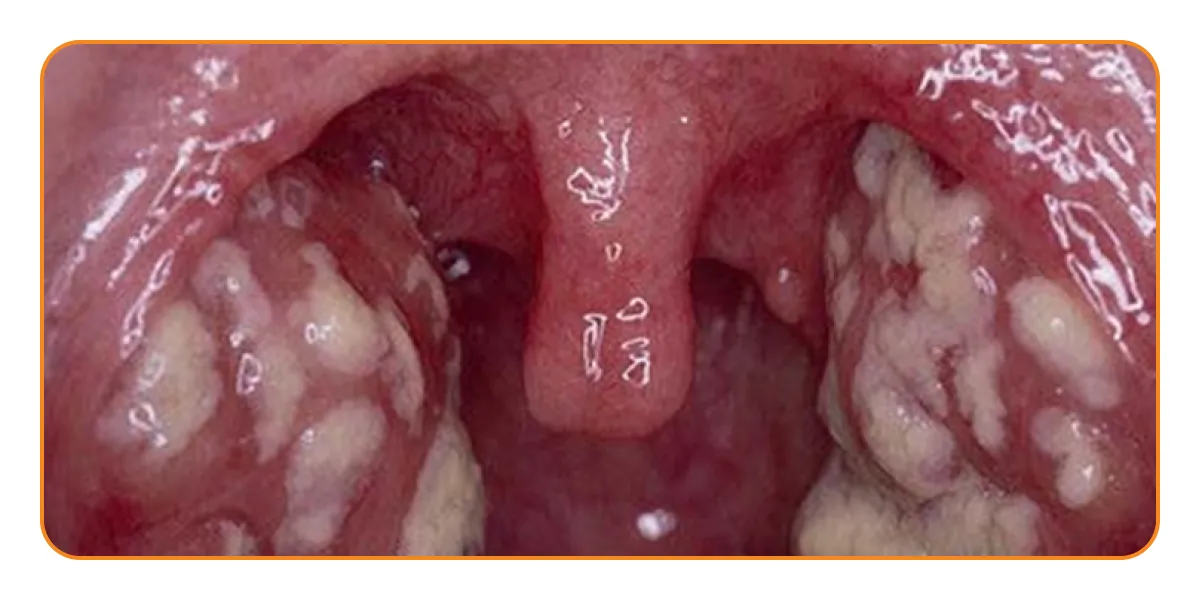 Воспаление миндалин у ребенка