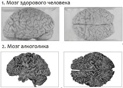 Загадочные паттерны мозговой активности: алкоголь и норма