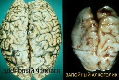 Мозг алкоголика: визуализация важных различий